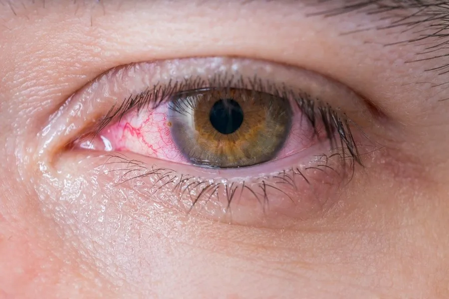 Right ways to deal with eye irritation
